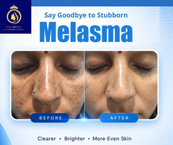 melasma Image (3) (1)