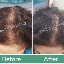 female-hair-loss-case (1)