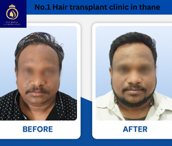 No.1 Hair transplant clinic in thane (3) (1)