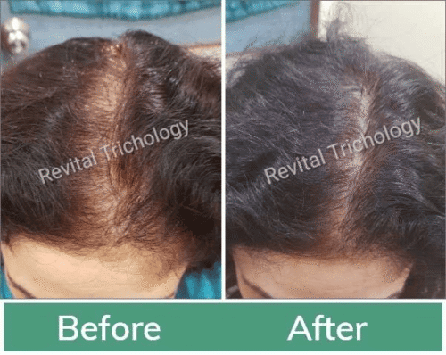 female-hair-loss-case (1) female-hair-loss-case (1)