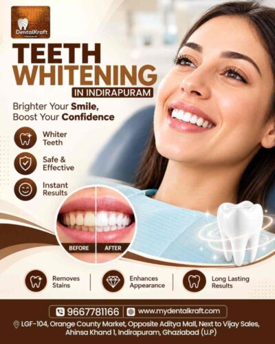 Teeth Whitening Treatment in Indirapuram for a Brighter Smile-100kb Teeth Whitening Treatment in Indirapuram for a Brighter Smile-100kb
