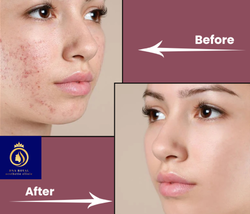 Laer Resurfacing Image (1)