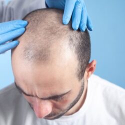 fue hair transplant in the UK