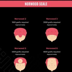 NORWOOD SCALE