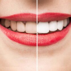 Teeth Whitening in Mount Roskill, Auckland